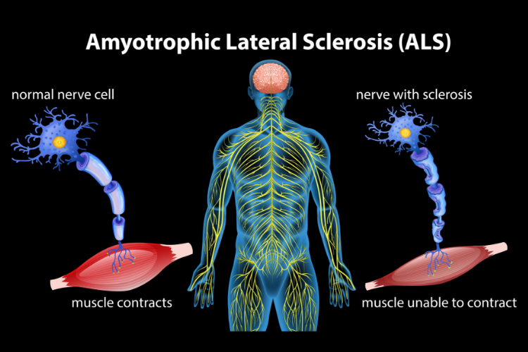 Cannabis and ALS diagram